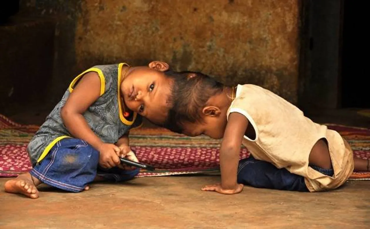 Conjoined twins from Odisha successfully separated in marathon surgery at AIIMS