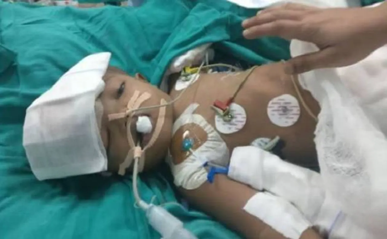 One of separated twins at AIIMS hospital opens eyes four days after marathon surgery