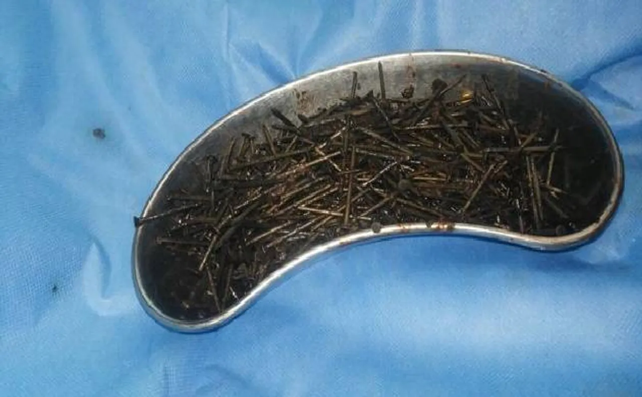 Kolkata: Man swallows 639 iron nails, doctors safely extract using magnet