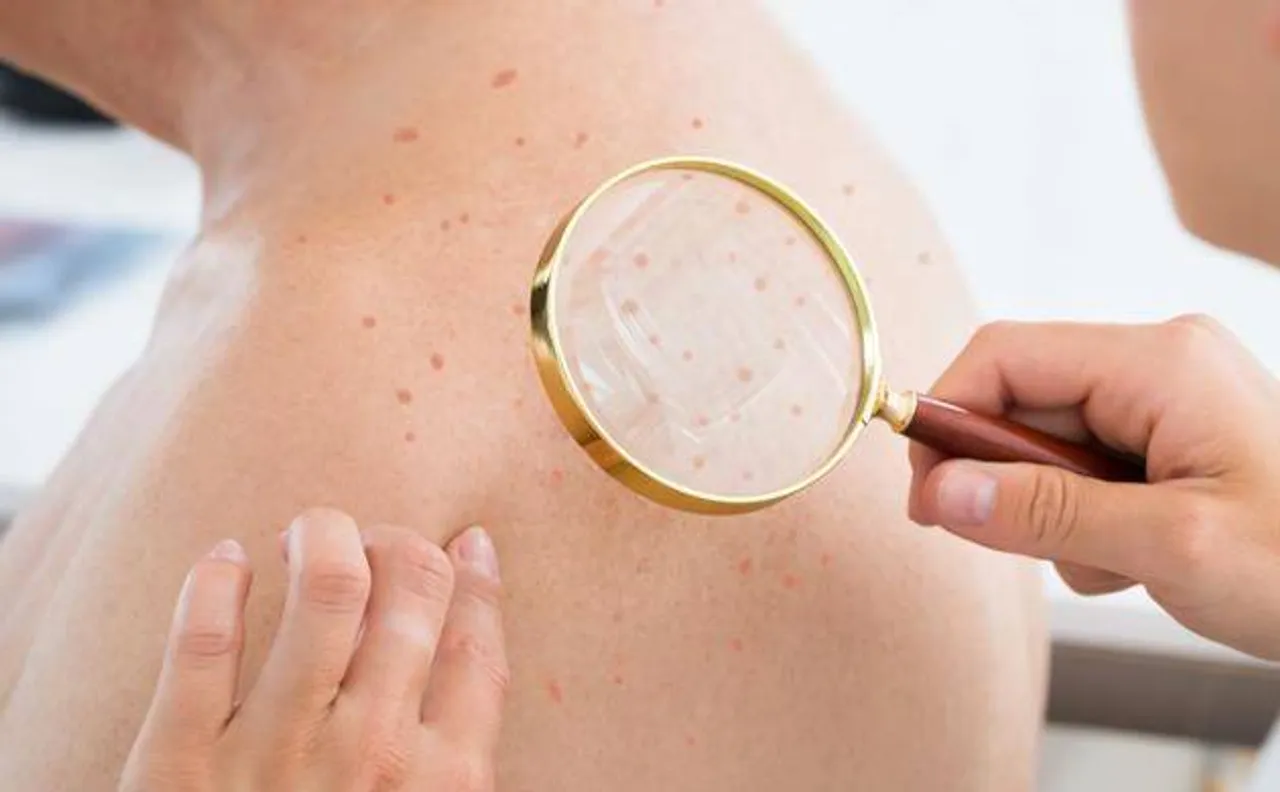 Darier's skin disease: First case reported in Uttar Pradesh