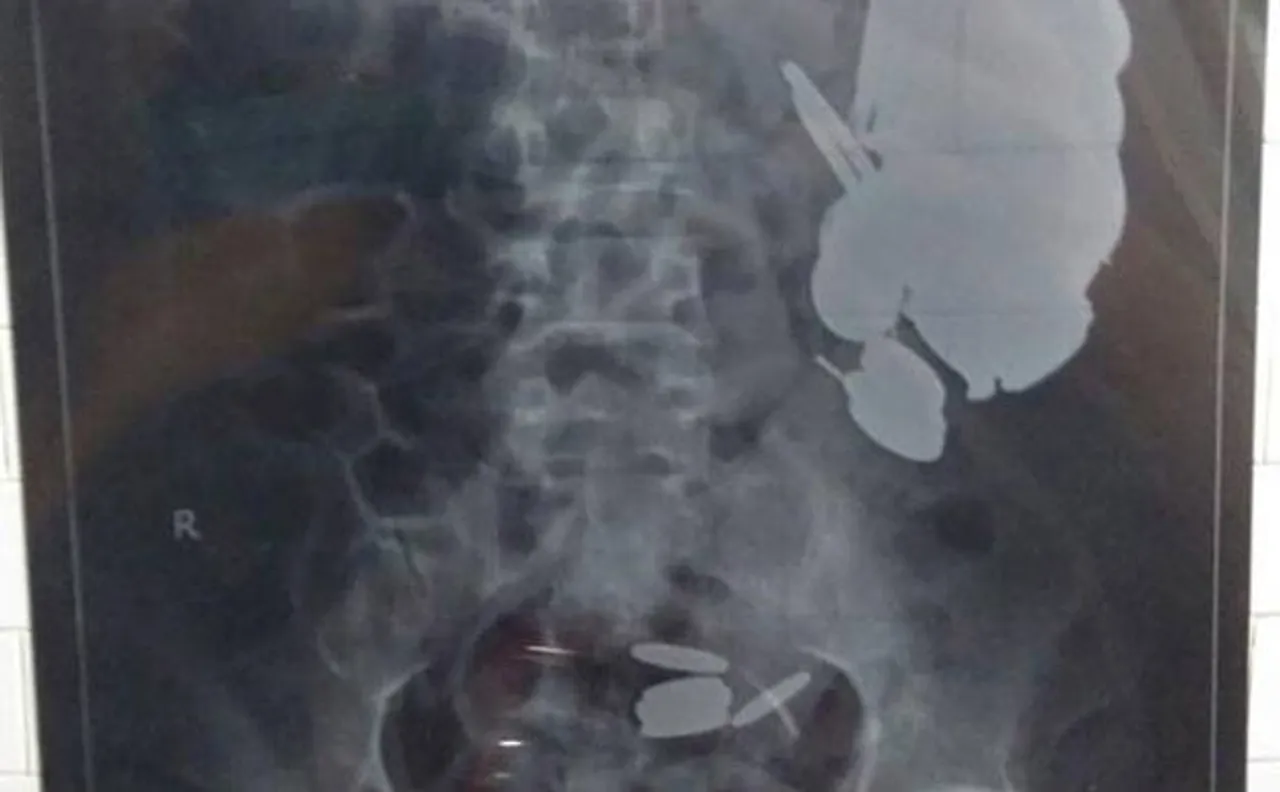 Doctors successfully remove 72 coins from Palghar man's stomach