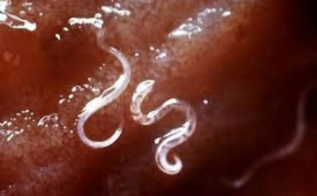 Undiagnosed hookworm could lead to huge blood loss: experts