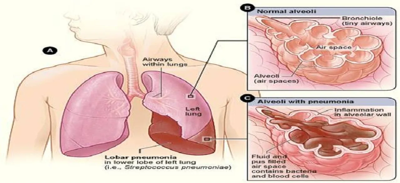 Pneumonia, major cause of death in India