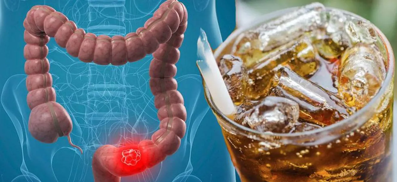Colon Cancer â€“ Diet Soda may help avoid recurrence