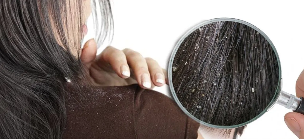 Home remedies to get rid of dandruff naturally
