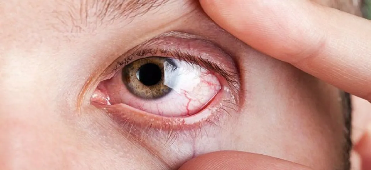 Dry Eye Syndrome: Easy and efficient ways to improve eye health