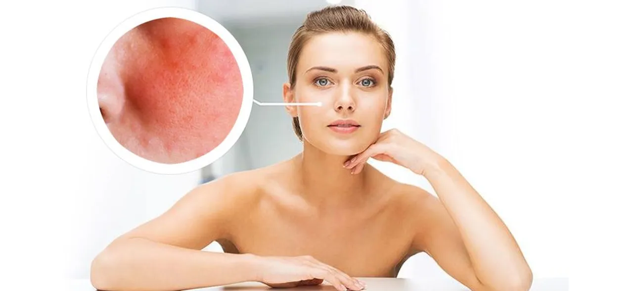 Eczema treatment: Easy home remedies to take care of this skin disorder