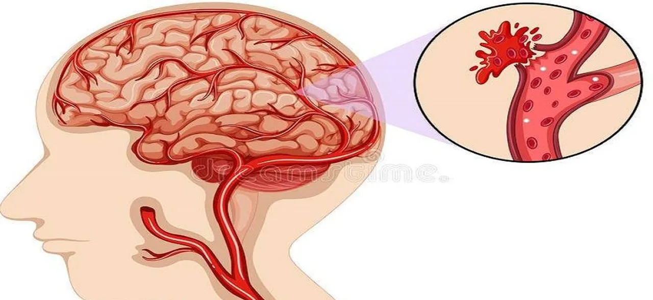A drug to reduce brain bleeding and risk of strokes identified