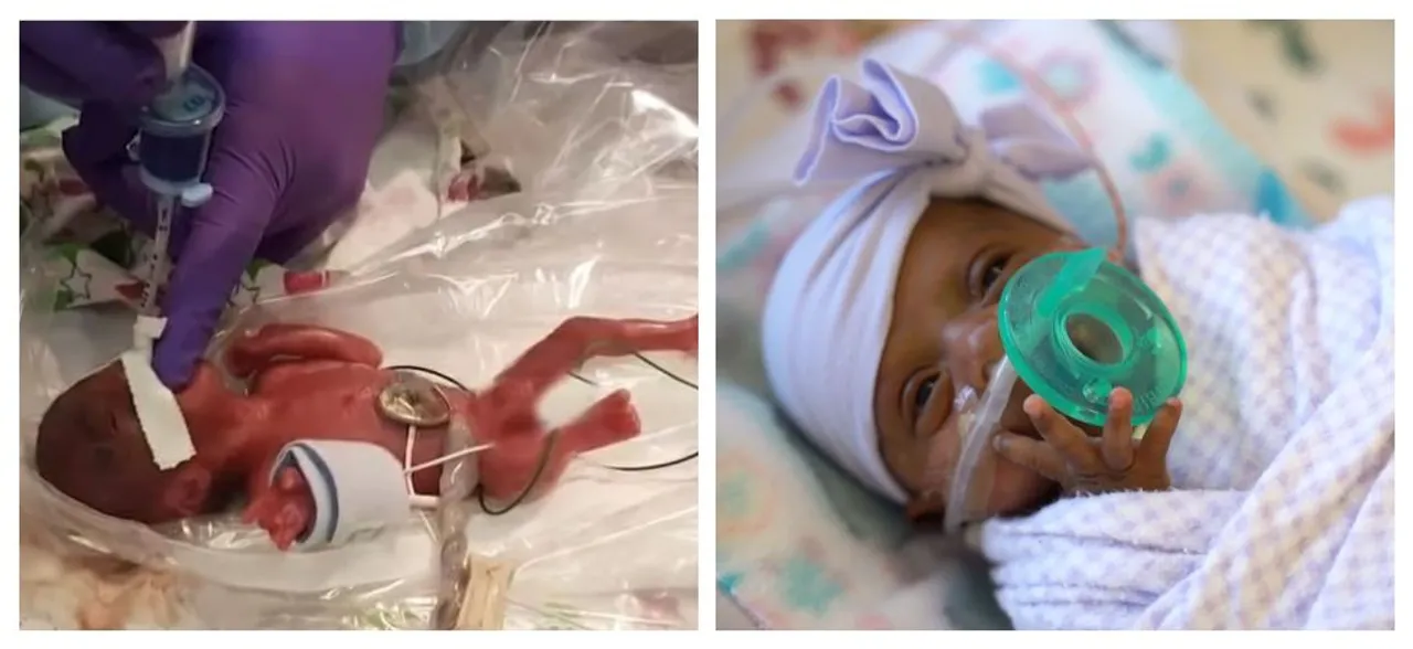 World's smallest baby, weighing no more than an apple is now a healthy infant, goes home after 5 months in intensive care