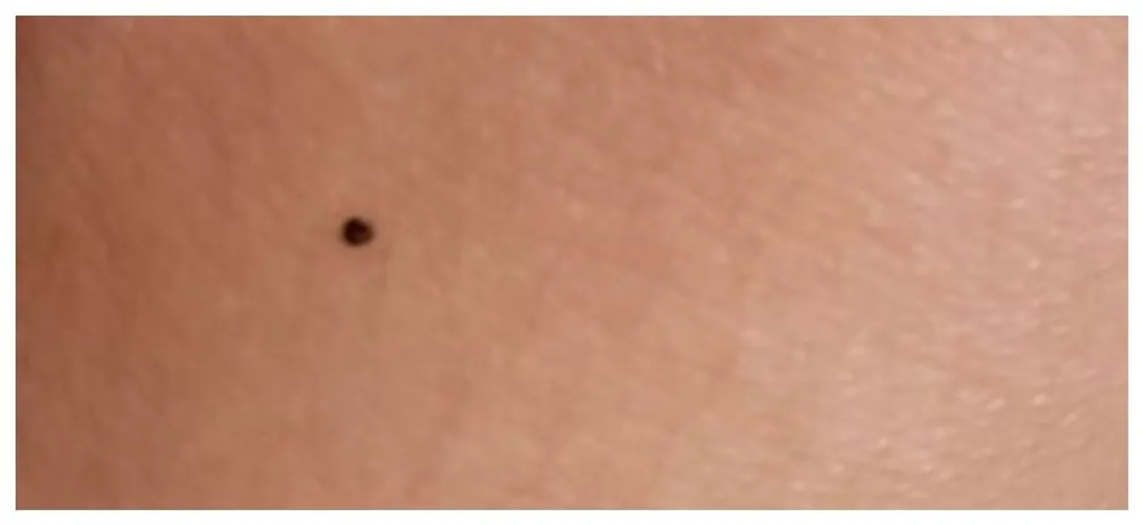 Women are freaking out over how loads of them have a freckle on SAME spot, do you have one too?
