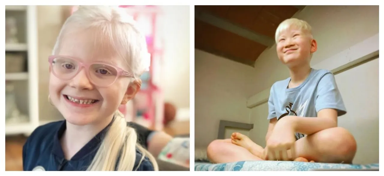 International Albinism Awareness Day 2019: Images of different people with the condition that shows being â€˜differentâ€™ is beautiful