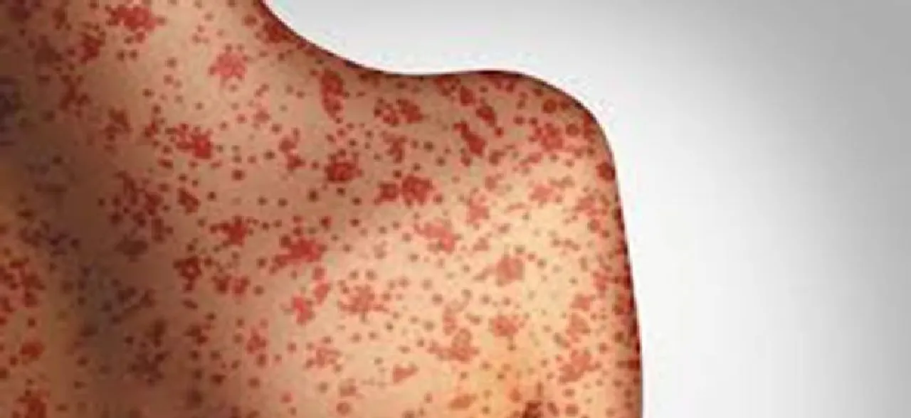 Measles Outbreak Wreaks Havoc In New Zealand: All About The Potentially Fatal Illness
