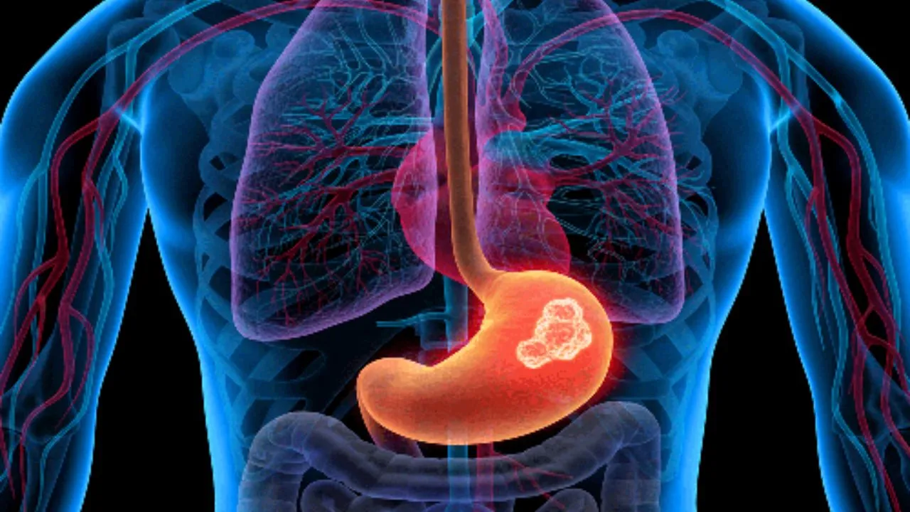 Stomach Cancer