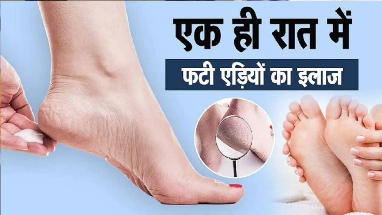 फटी एड़ियों का इलाज