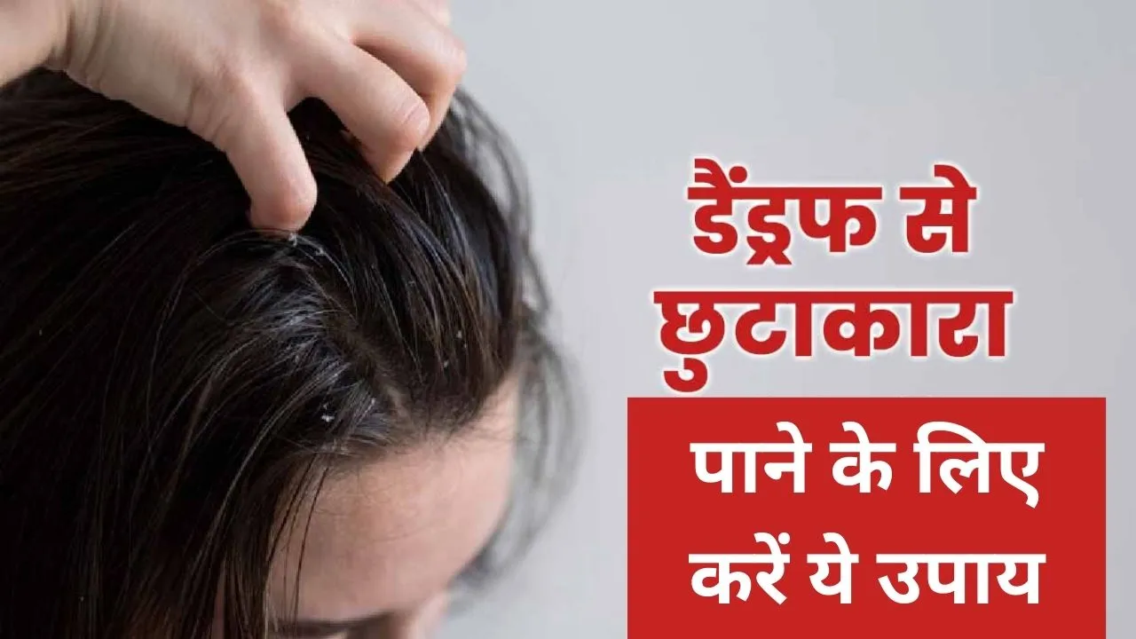 Home remedies to remove dandruff