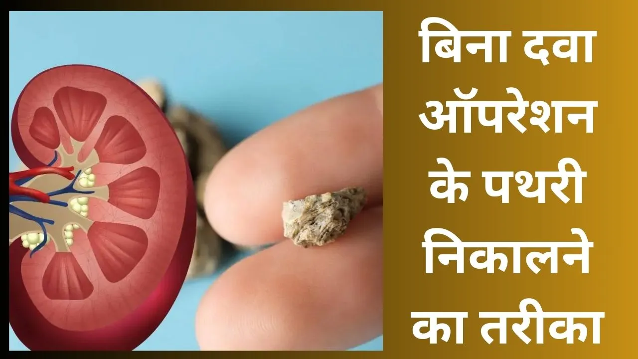 How to remove stone in urinary bladder