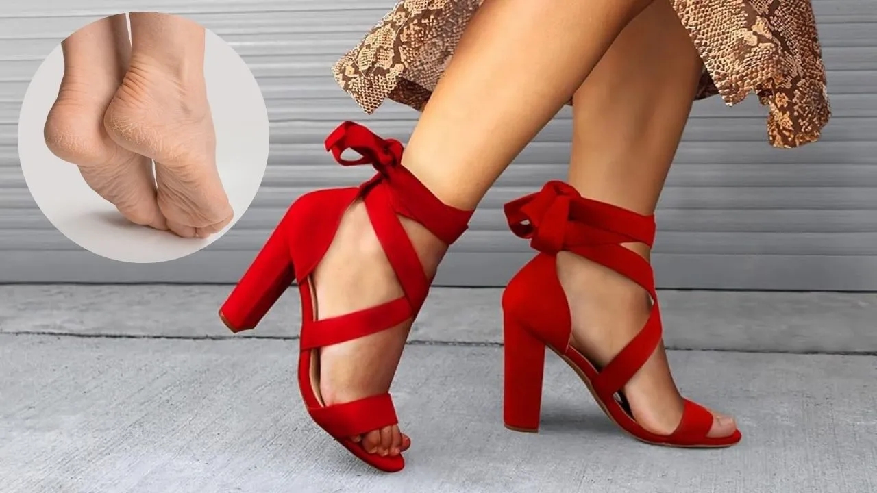 cracked heels 
