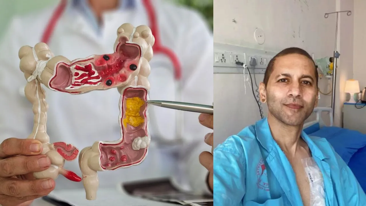 Colon Cancer- विभु राघव