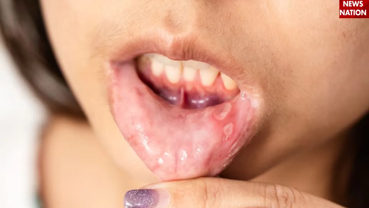 mouth ulcers