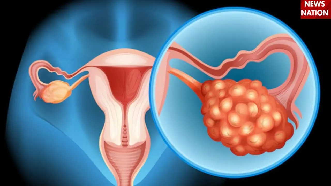 Ovarian Cancer