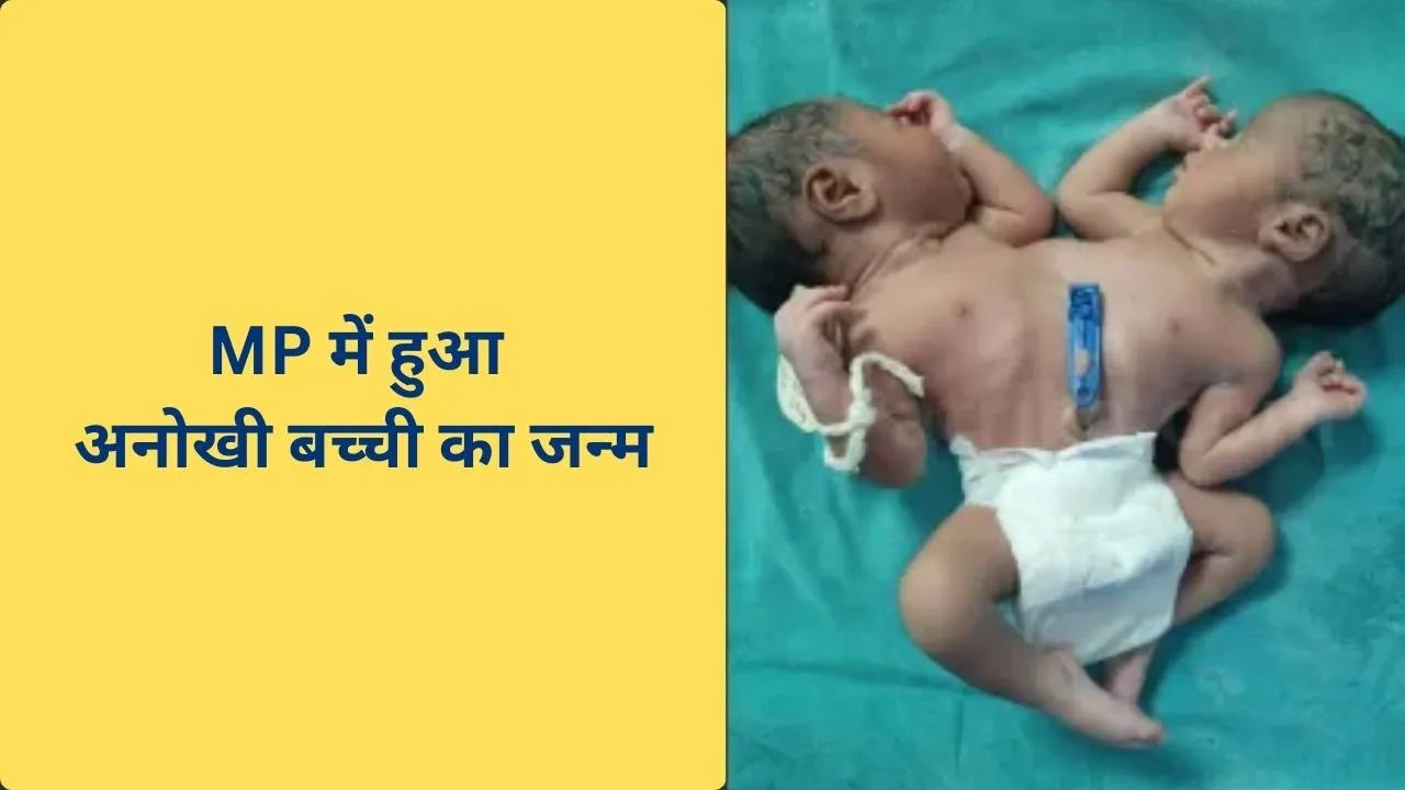 Twin head child born in MP