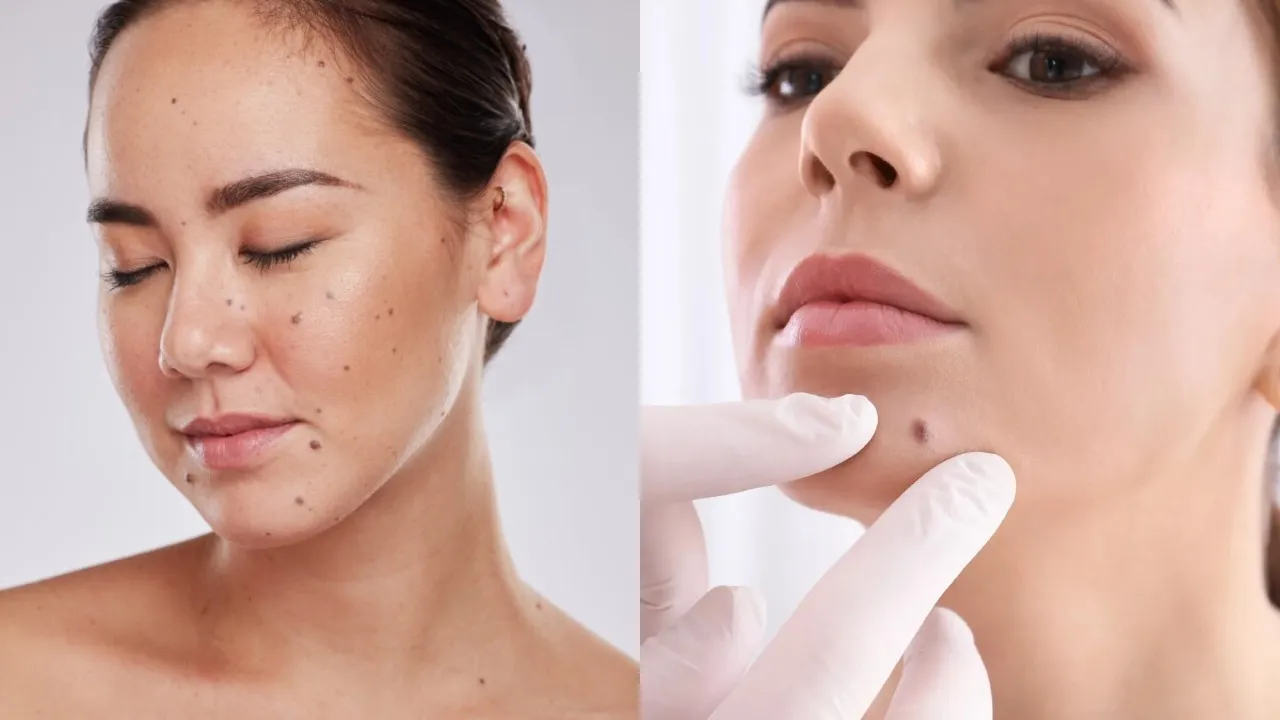 Mole On Face