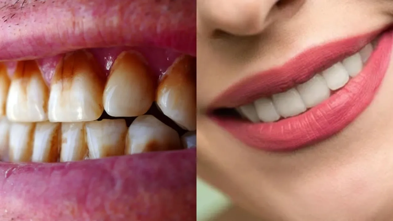 Teeth Whitening Tips