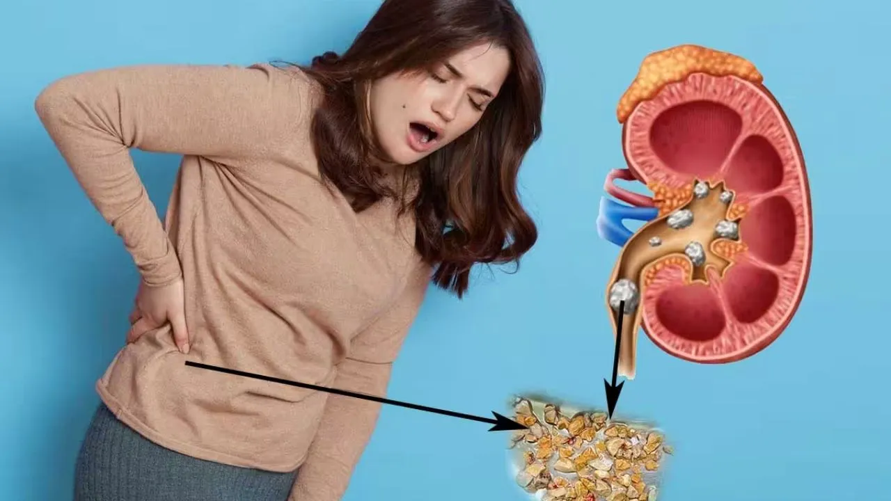 kidney stones