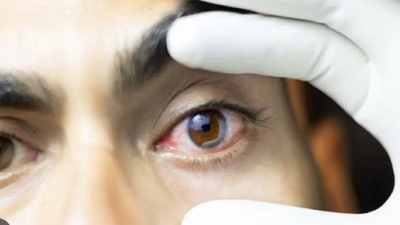 eye infection
