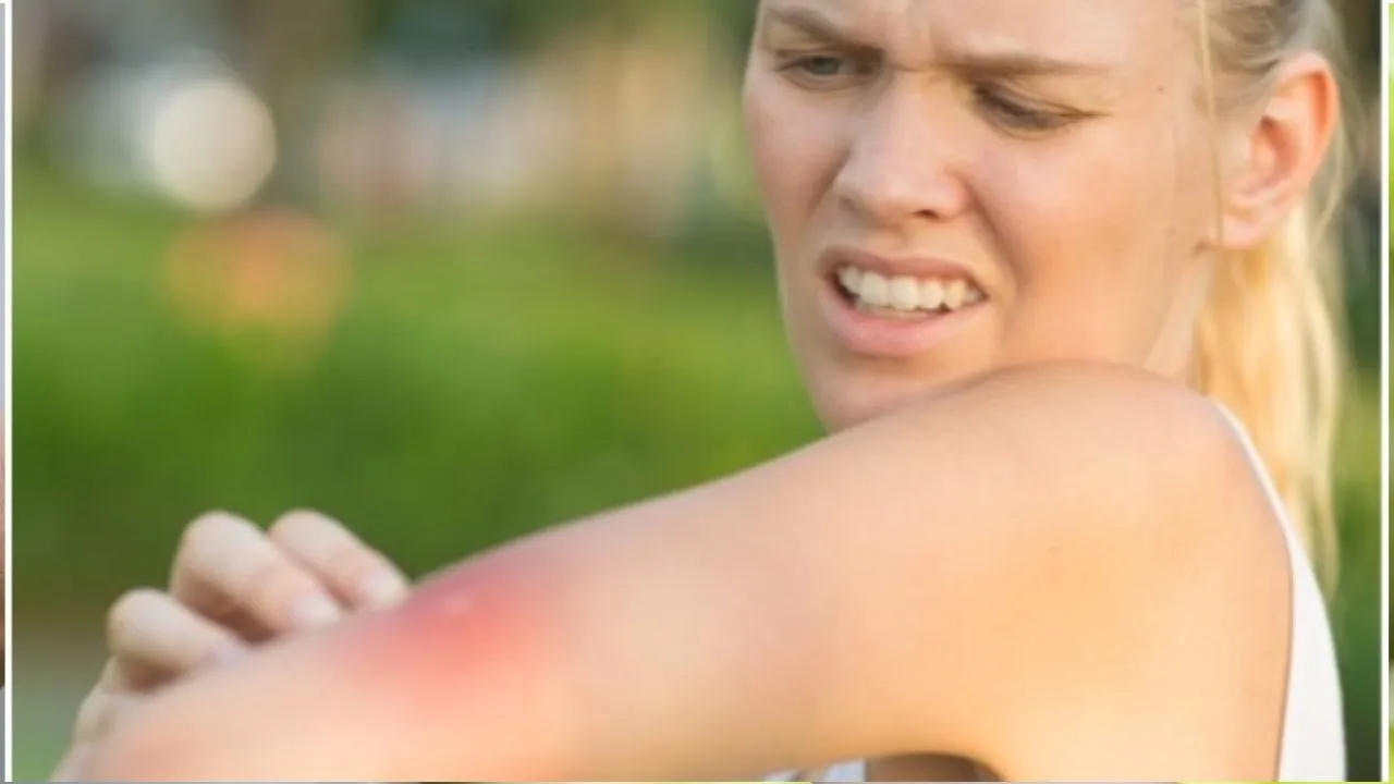mosquitoes bite 1