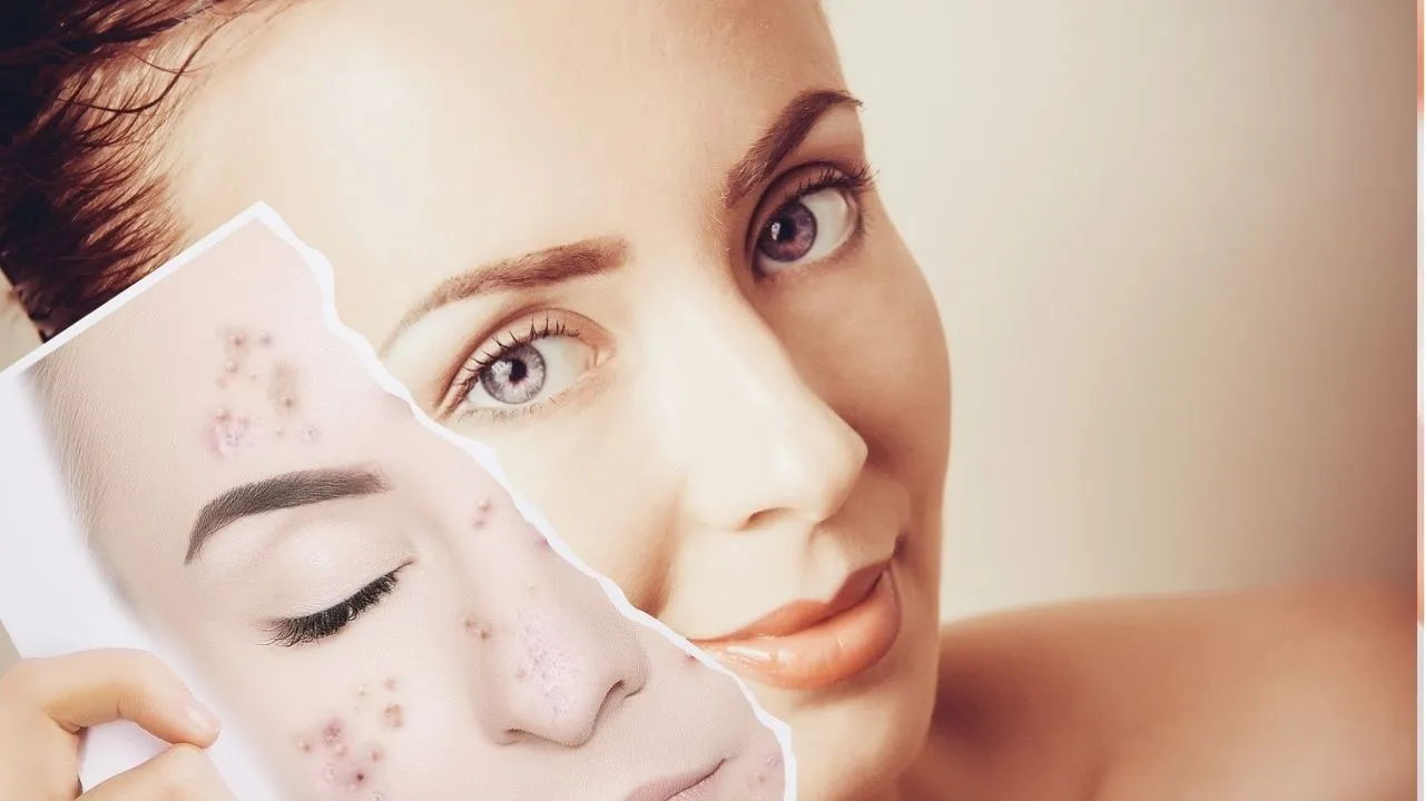 Acne Free Skin