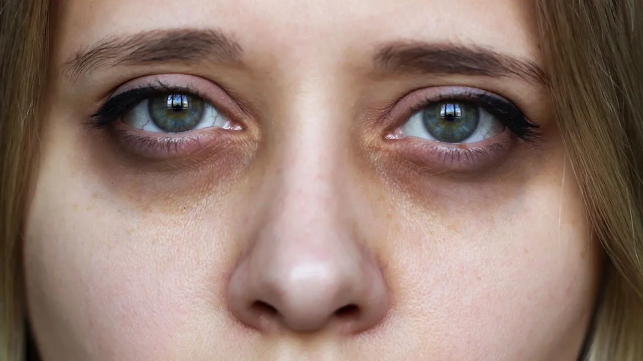 How to remove dark circles