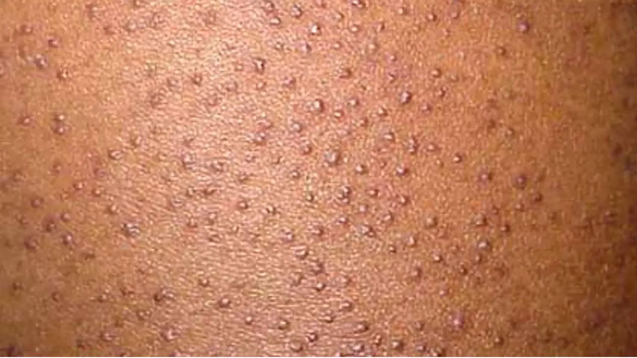 keratosis pilaris
