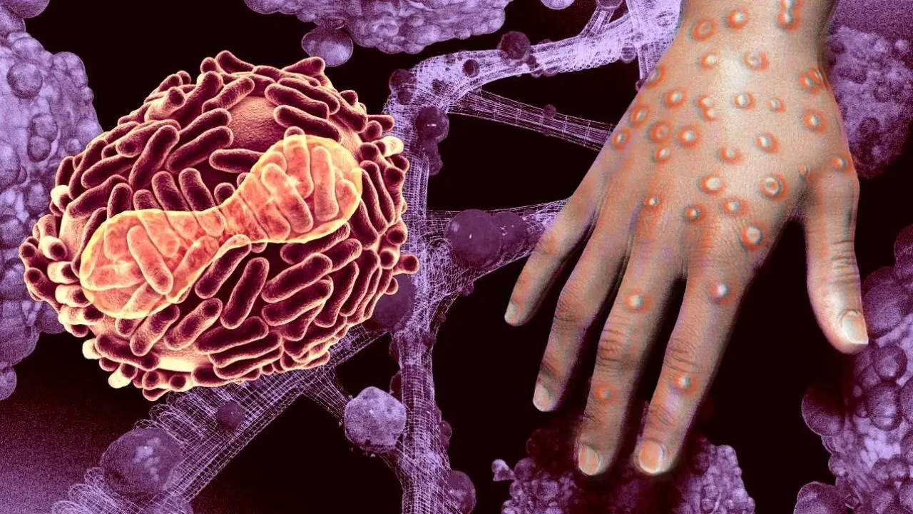 Monkey pox Virus
