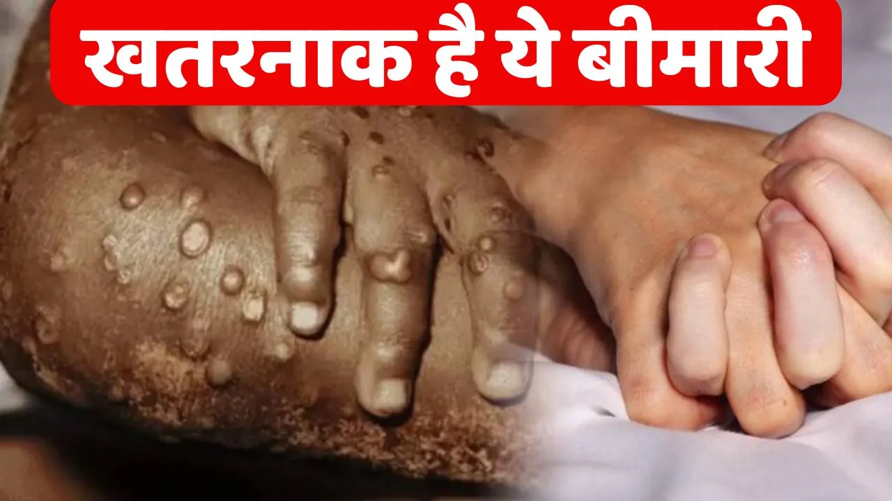 Monkey Pox Virus