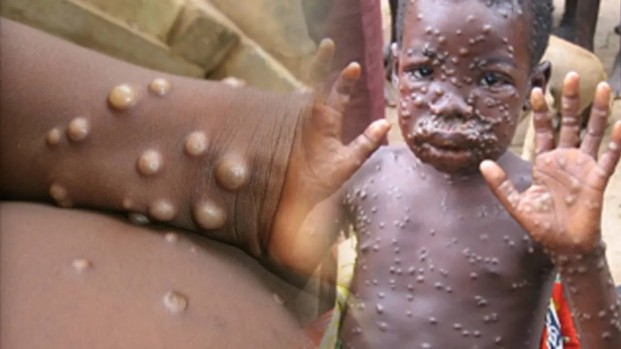 Monkey Pox