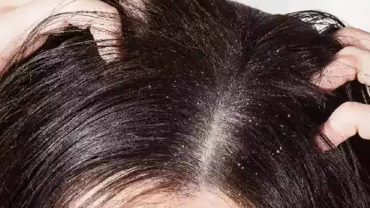Can dandruff increase