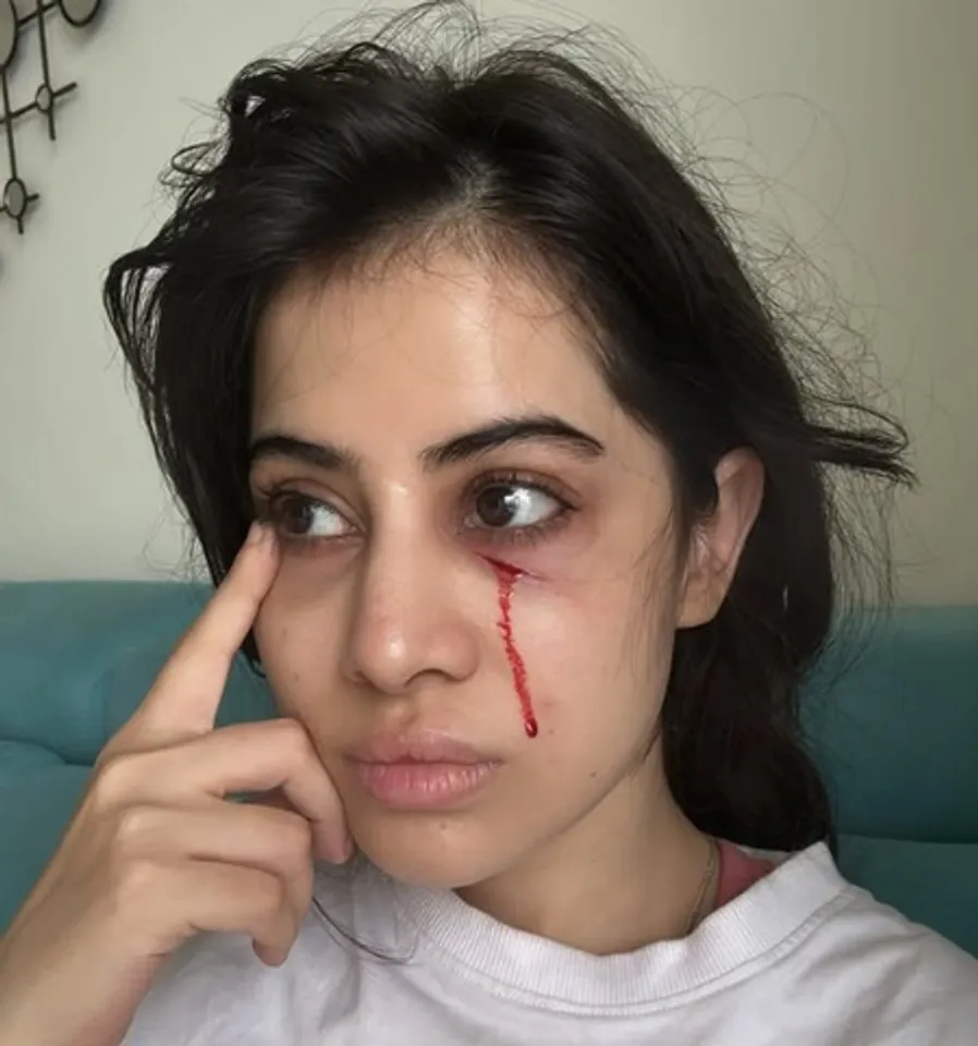 उर्फी जावेद को लगी चोट, चेहरे से बहता दिखा खून