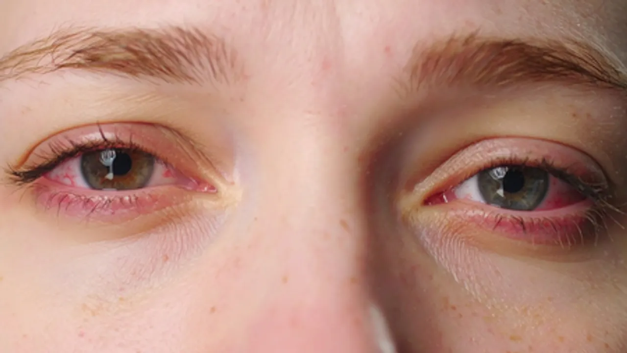 City doctors report 50 pc rise in eye problems as smog continues to engulf Delhi