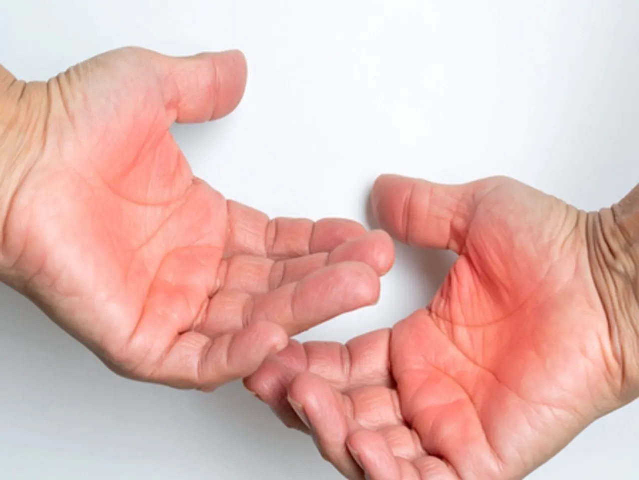 जलने से होने वाली जलन से तुरंत राहत देंगे ये घरेलू नुस्खे, नहीं पड़ेगा त्वचा पर कोई दाग