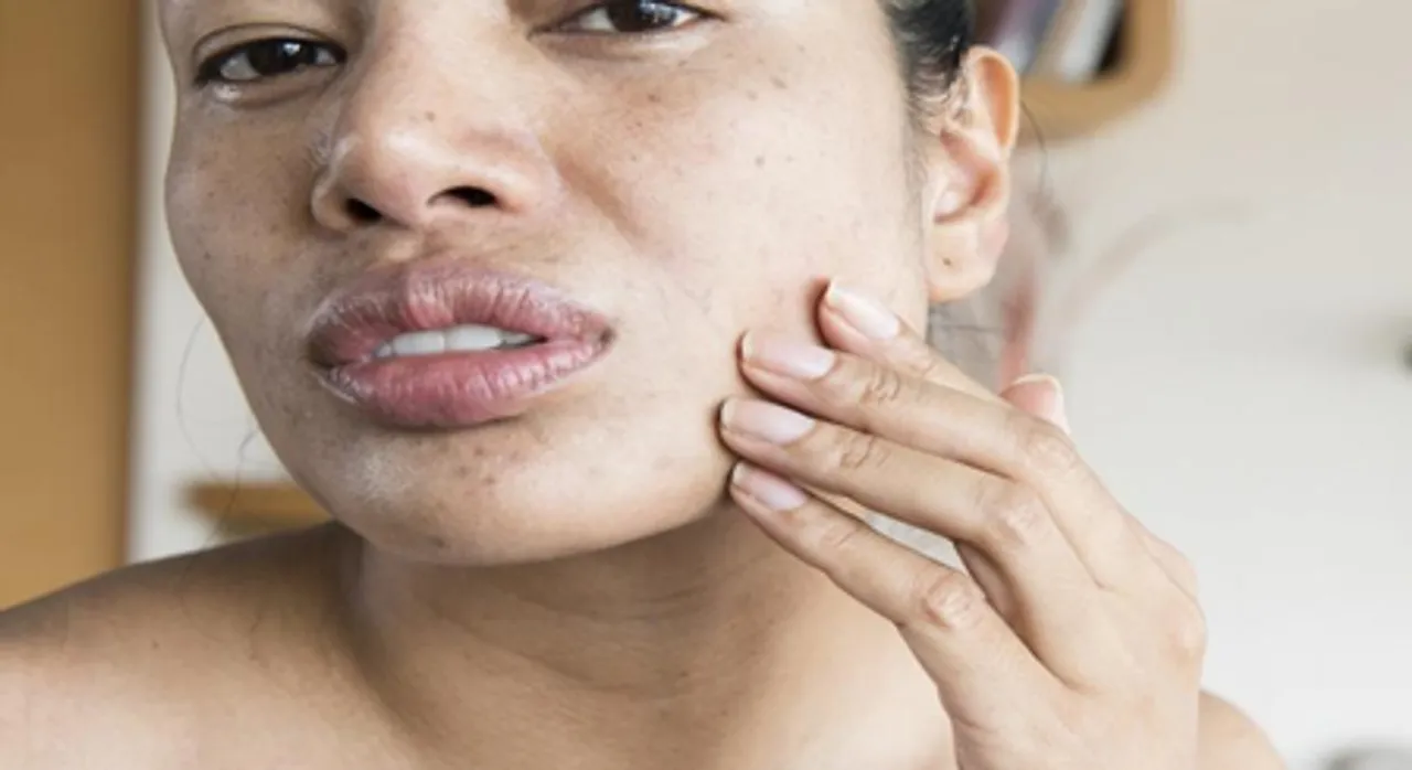सर्दियों में रुखी त्वचा के लिए अपनाएं ये चीजें, नमी के साथ-साथ बढ़ेगी चेहरे की चमक