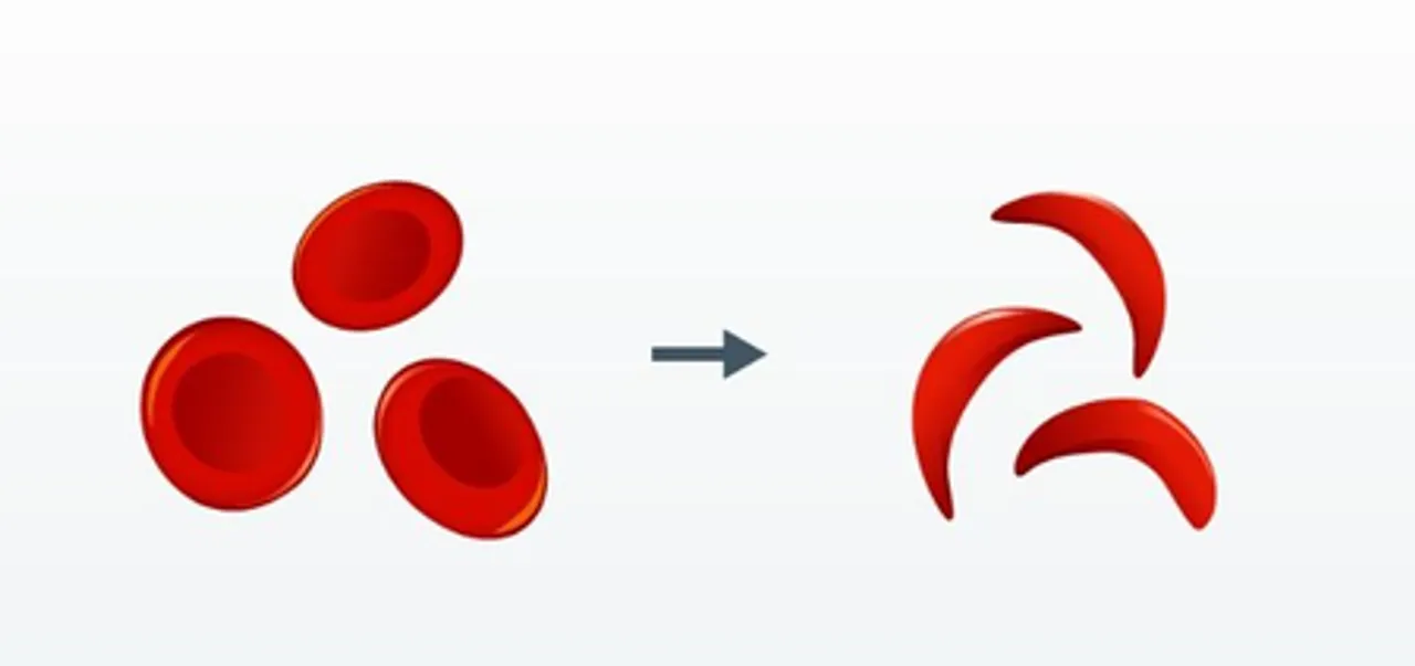 India launches 1st indigenous CRISPR-based gene therapy for Sickle Cell Disease