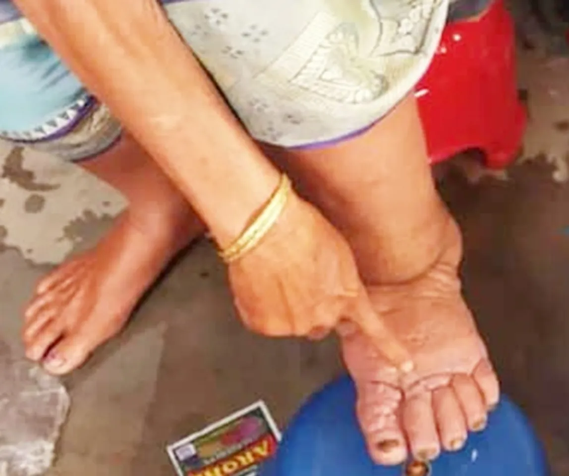 UP to launch triple drug therapy to counter filariasis