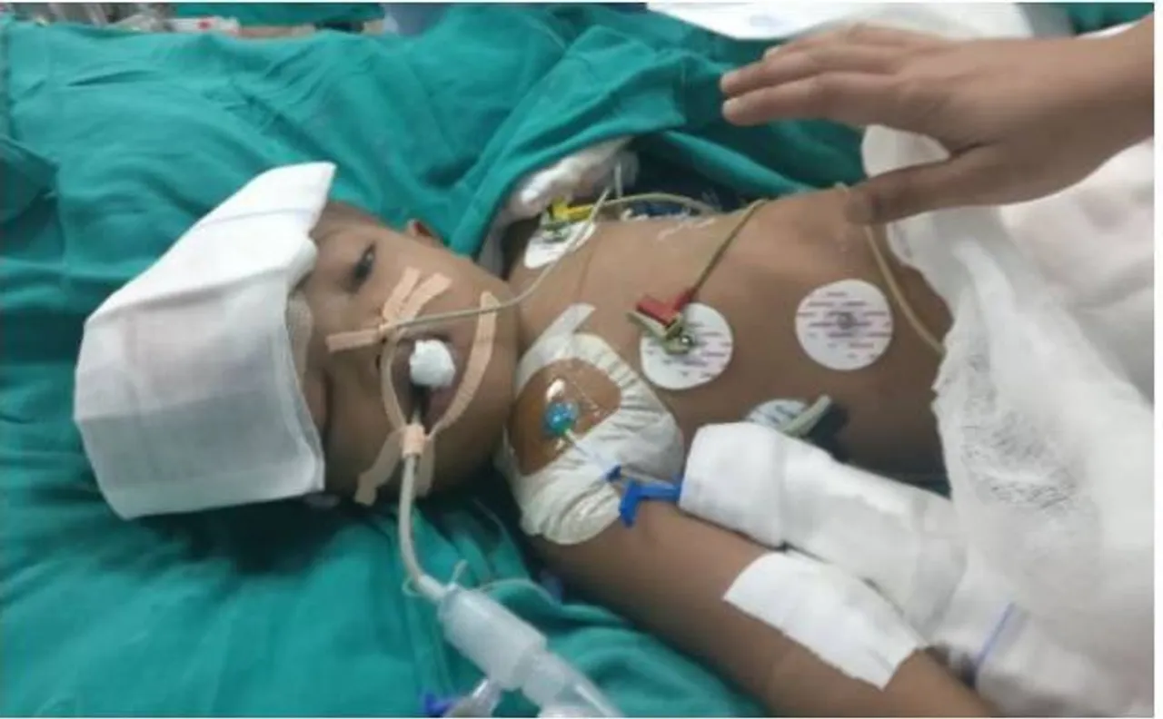 देश में पहली बार सिर से जुड़े बच्चों को अलग करने की सर्जरी सफल, AIIMS में हुआ ये अनोखा ऑपरेशन