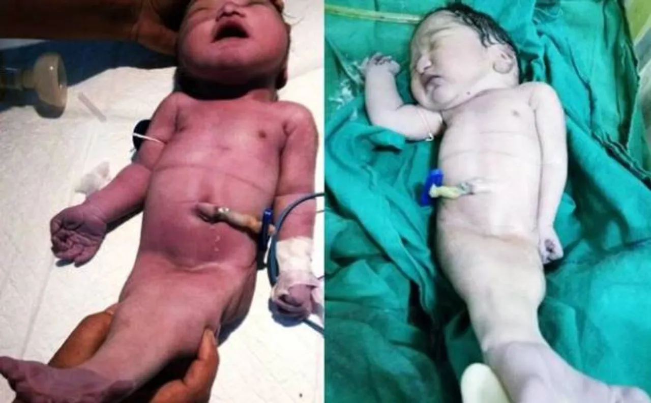 कोलकाता में पैदा हुए 'जलपरी बच्चे' ने चार दिन बाद तोड़ा दम, डॉक्टर्स नहीं पता लगा पाए लिंग