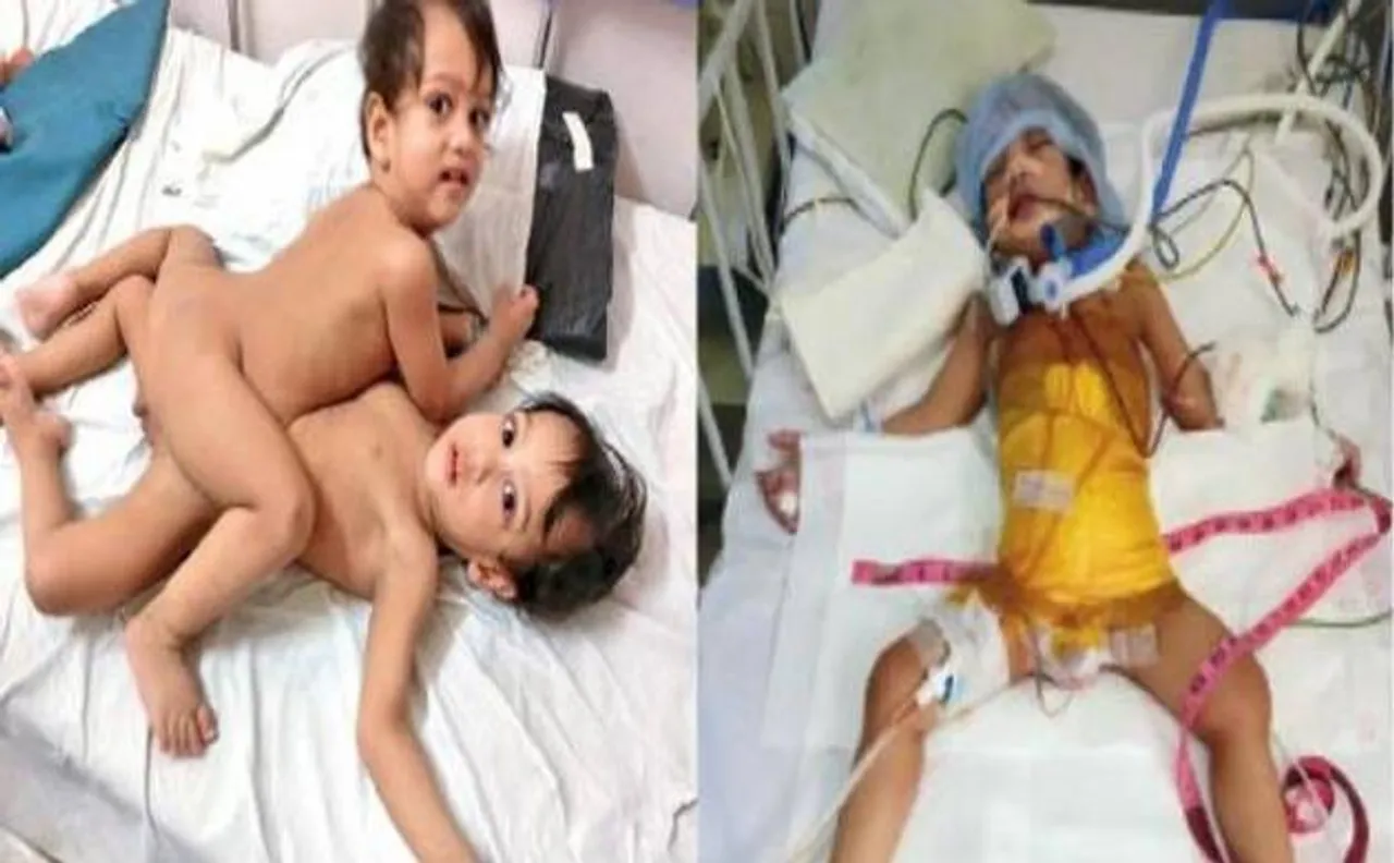 मुंबई: 12 घंटे चली सर्जरी से अलग किये गये लव और प्रिंस, कई अंग थे आपस में जुड़े
