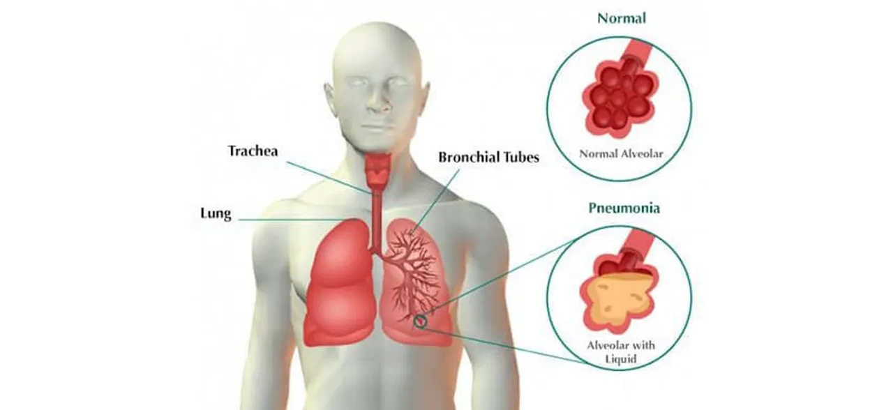 pneumonia day: निमोनिया से ऐसे बचाएं अपने लाडलों को, नहीं छिनेगी उनकी मुस्‍कान