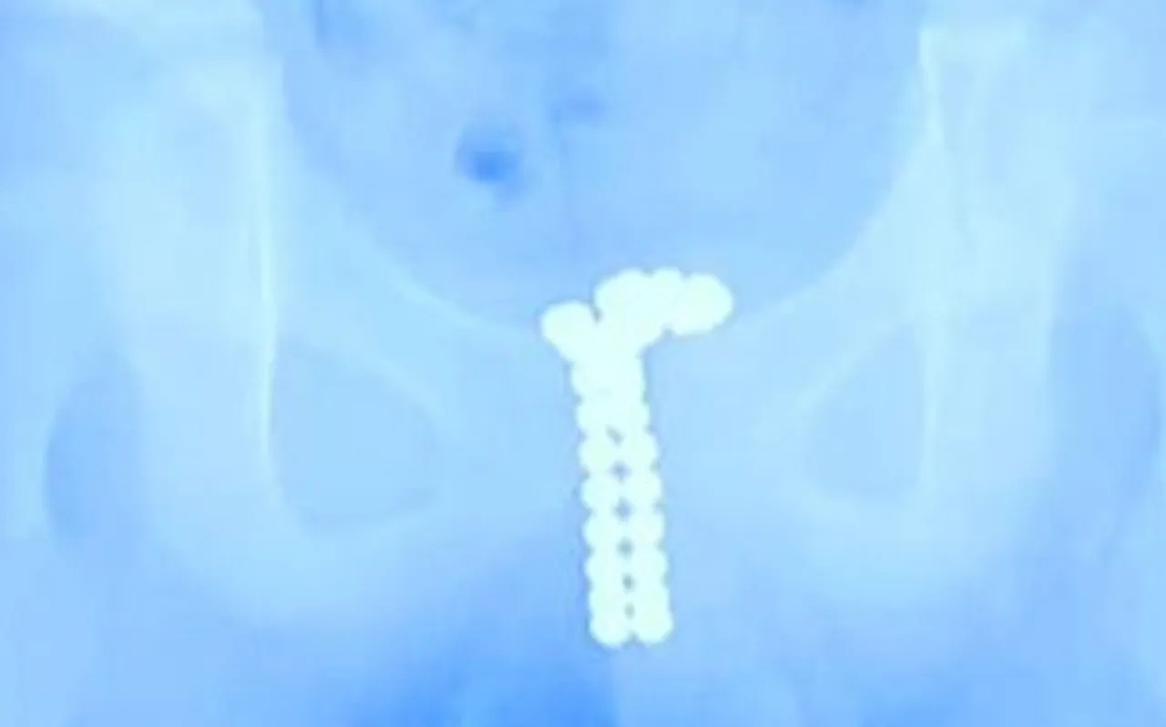 लड़के के प्राइवेट पार्ट में हो रहा था भयानक दर्द, X-Ray रिपोर्ट में सामने आई ऐसी तस्वीर.. पैरों तले खिसक गई जमीन