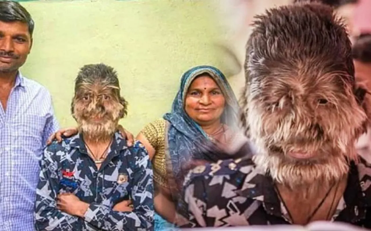 पूरे चेहरे पर उग आते हैं घने बाल, बच्चे ने गंभीर बीमारी के आगे कभी नहीं टेके घुटने, भावुक कर देगी कहानी