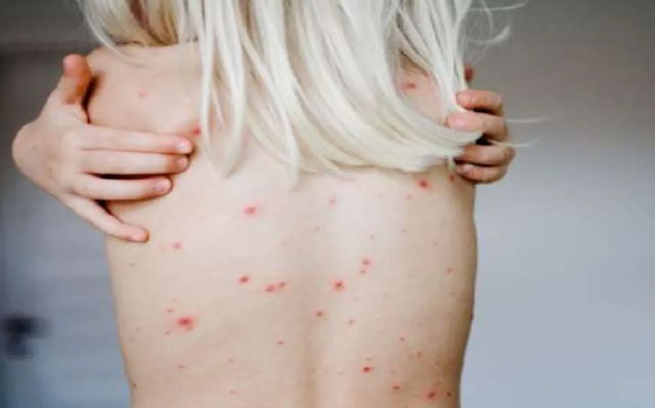 HIV से भी ज्यादा खतरनाक है ये बीमारी, यौन संक्रमण से फैलकर सुला रही मौत की नींद